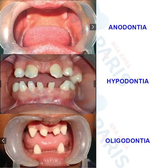 răng không mọc được anodontia