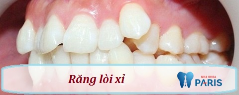 Bạn có thể tham khảo thêm về tình trạng hàm răng 9630 - một trường hợp nặng hơn của răng mọc lòi sỉ