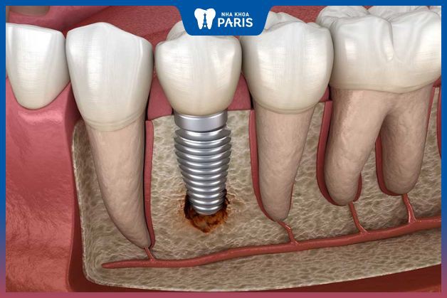 Kỹ thuật trồng implant kém sẽ gây viêm, tiêu xương răng