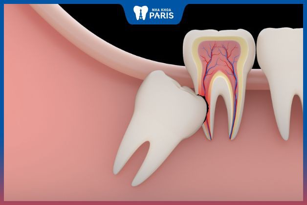 Cần nhổ răng khôn tránh ảnh hưởng tới răng 7