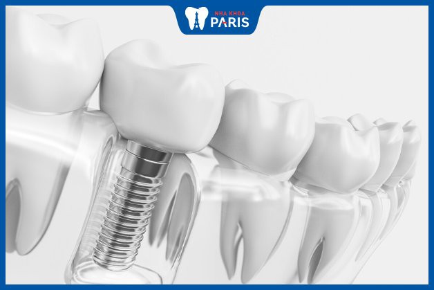 Răng ác tính sẽ bị nhổ bỏ và trồng lại răng implant đúng vị trí