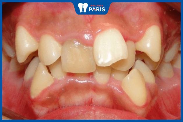 Răng mọc ngược có thể gây những căn bệnh nguy hiểm cho răng miệng