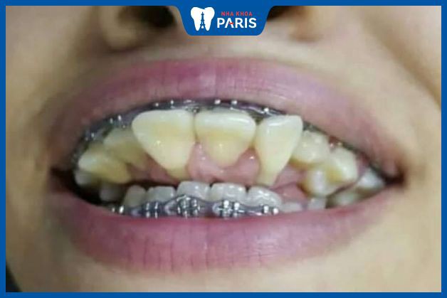 Hình nền Nền Mô Hình Của Một Chiếc Răng đã được Thực Hiện Nền, Hình ảnh Lỗ  Sâu Trên Răng, Răng, Bác Sĩ Nha Khoa Background Vector để tải xuống miễn  phí -