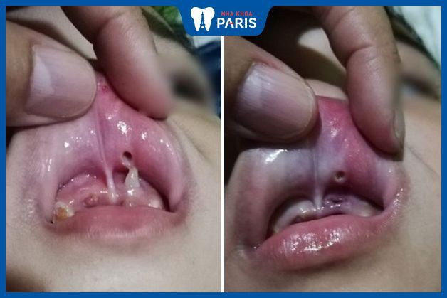 Răng mọc ngược ở trẻ em gây ra tổn thương nướu nghiêm trọng