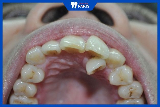 Có nhiều lý do khiến răng mọc trong vòm miệng