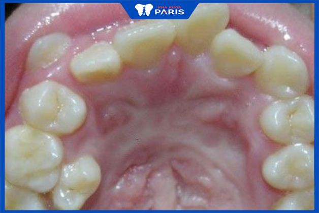 Răng mọc trong vòm miệng là gì?