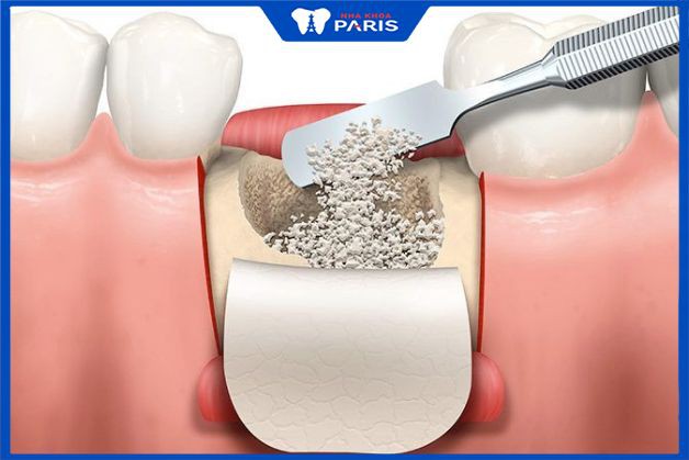Răng thừa dễ gây tổn thương khi cấy ghép ổ xương răng