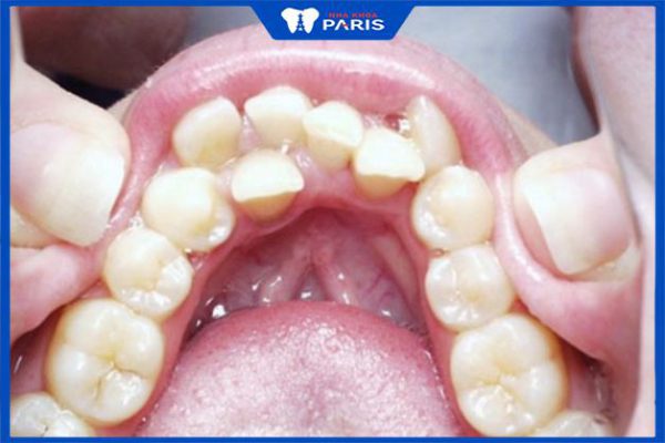 Răng mọc trong vòm miệng – Nguyên nhân, biến chứng