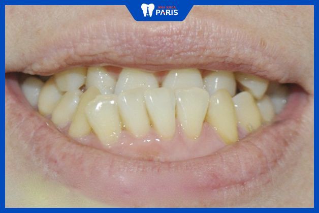 Răng bị móm có thể kèm theo hiện tượng răng khấp khểnh.
