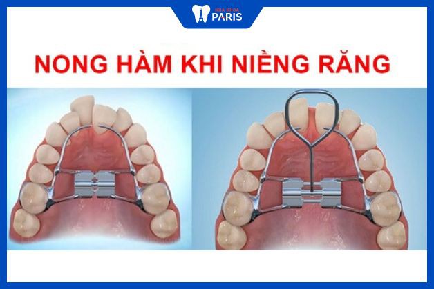 Nong hàm chỉnh nha là giải pháp niềng răng móm hiệu quả, không phải nhổ răng.