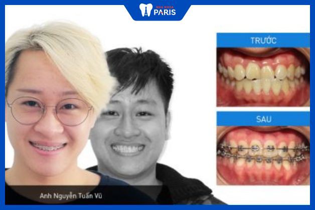 Trường hợp khách hàng tại nha khoa Paris cần nhổ răng để niềng răng bị móm.