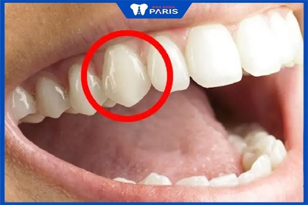 Răng nanh nằm ở vị trí thứ 3 trên cung hàm và thường có hình thù sắc, nhọn