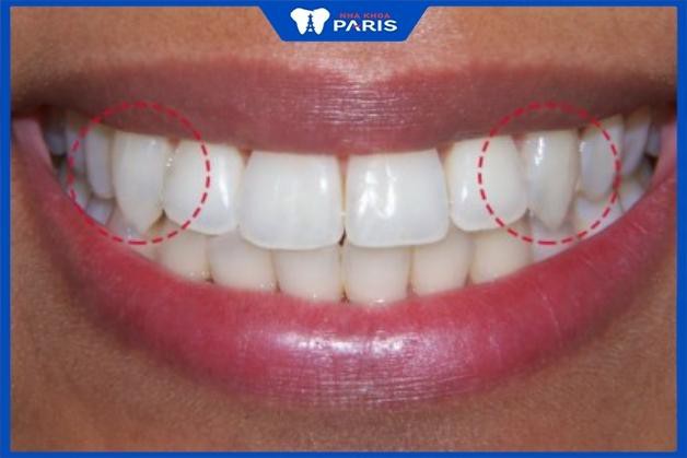 Răng nanh tự nhiên thường có hình thù sắc, nhọn