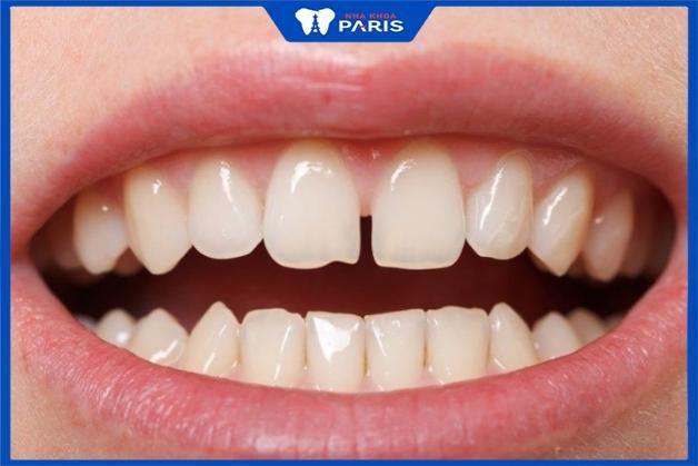Mỗi người thường có 4 chiếc răng nanh ở hai hàm trên và dưới