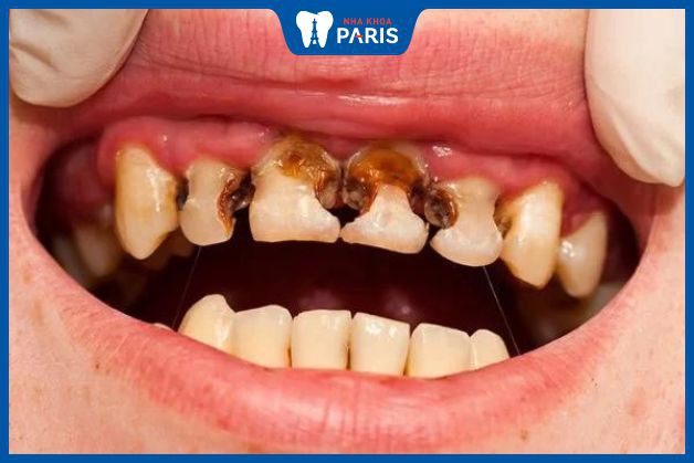 Sâu răng đến tủy có thể tấn công lan sang các răng khác