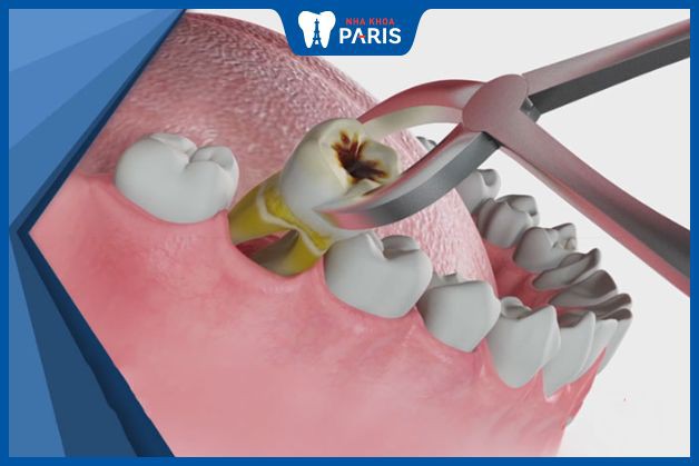 Răng sâu tới tủy quá nặng thì buộc phải nhổ và trồng răng mới