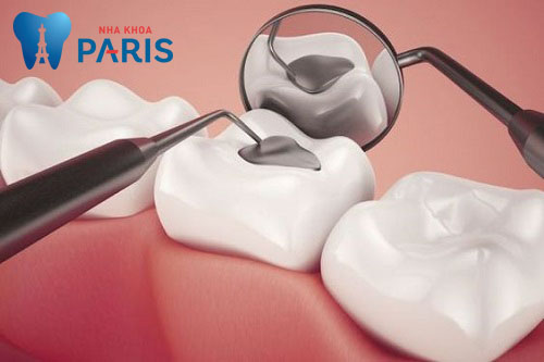 Tại Paris Dental Implant dịch vụ hàn trám răng thẩm mỹ được rất nhiều khách hàng phản hồi tốt với công nghệ trám răng Laser Tech 4.0. Tìm hiểu chi tiết hơn về công nghệ này tại đây