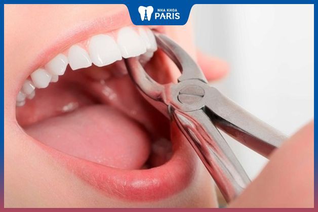 Nhổ răng số 4 gây ra nhiều tác hại lâu dài