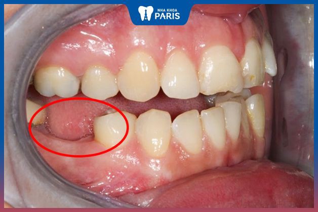 Mất răng số 4 để lại nhiều hệ lụy nếu không chữa trị kịp thời