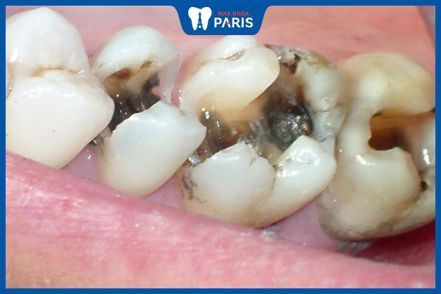 Sâu răng phát triển từ nơi mất răng