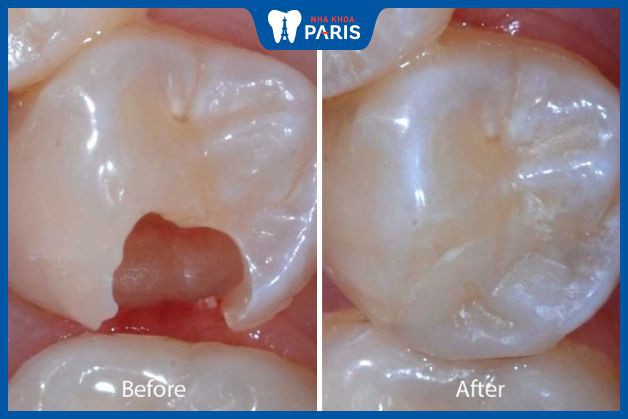 Kết quả điều trị răng số 6 bị bể bằng hàn trám răng.