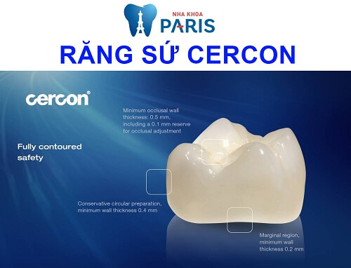 Răng sứ Cercon là gì