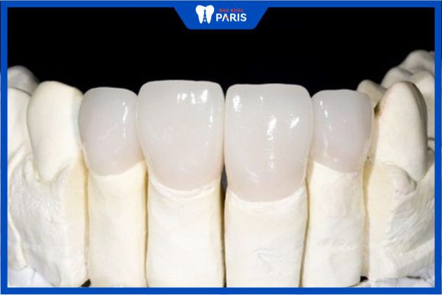 Răng sứ HT Smile mang hầu hết ưu điểm của các loại răng sứ khác