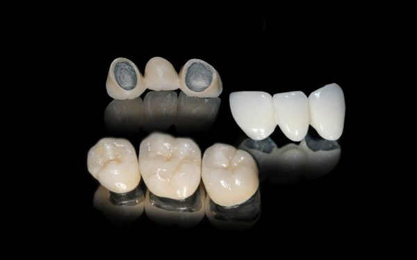 Răng sứ kim loại sử dụng được bao lâu? Mẹo giúp tăng tuổi thọ