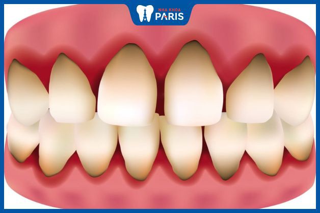Răng kim loại sẽ xảy ra tình trạng đen răng, đen nướu sau vài năm sử dụng