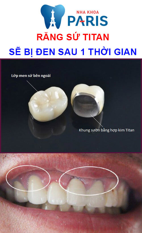 Bọc răng sứ titan có tốt không