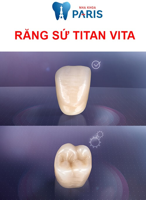Răng sứ titan vita