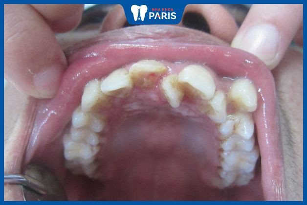 Hình ảnh răng mọc thừa ở hàm trên
