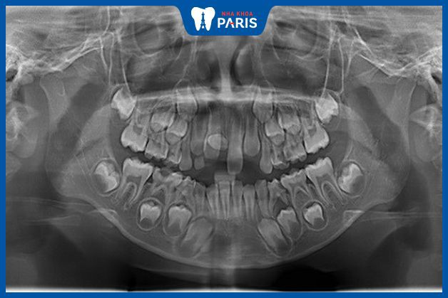 Phim X-quang chụp răng thừa mọc ngầm trong hàm