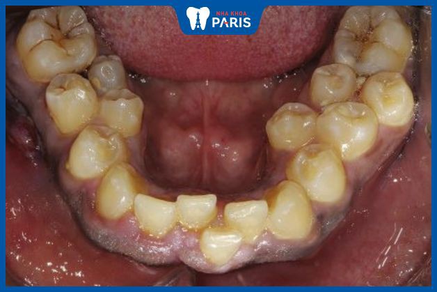 Răng mọc thừa có thể do di truyền hoặc đột biến