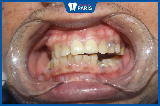 Răng sứ kim loại dễ bị đen nướu và hỏng dần sau vài năm