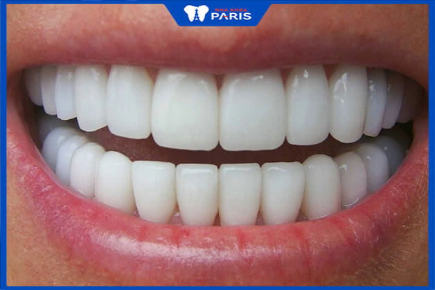 Răng toàn sứ là loại răng gì