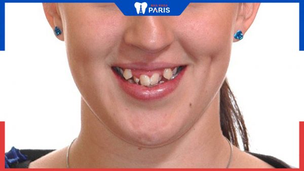 Răng xấu là gì? Nguyên nhân và phương pháp khắc phục hiệu quả