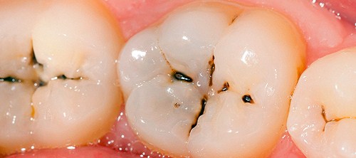 Triệu chứng điển hình của răng sâu là xuất hiện những lỗ nhỏ li ti