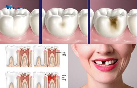 Sâu răng đến tủy có thể mất răng vĩnh viễn và lan dần sang các răng bên cạnh.