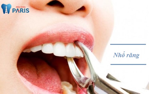 Nhổ răng - Phương pháp khắc phục tình trạng sâu răng nghiêm trọng