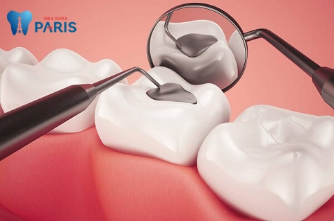 Tùy vào mức độ nặng nhẹ nha sĩ sẽ đưa phương pháp trám răng hay bọc răng để điều trị