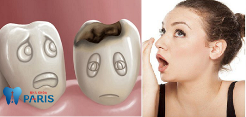 Sâu răng có gây hôi miệng không? Chữa thế nào DỨT ĐIỂM 100%