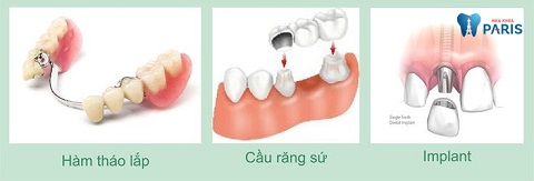 , có 3 phương pháp trồng răng được áp dụng phổ biến