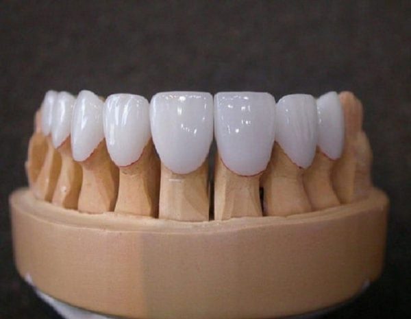 So sánh răng sứ kim loại và răng toàn sứ, loại răng sứ nào tốt hơn?