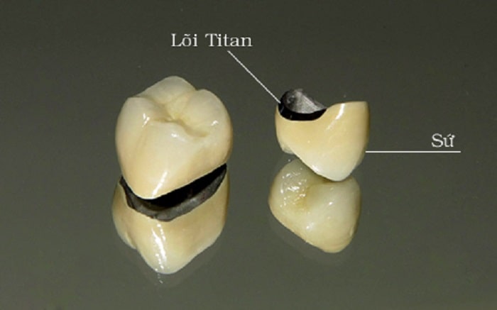 Răng sứ thường có 2 phần