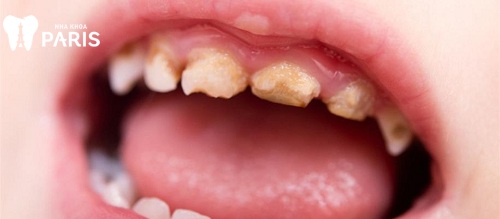 Hàm răng sún là gì? Bé bị sún răng phải làm sao? Cách trị sún