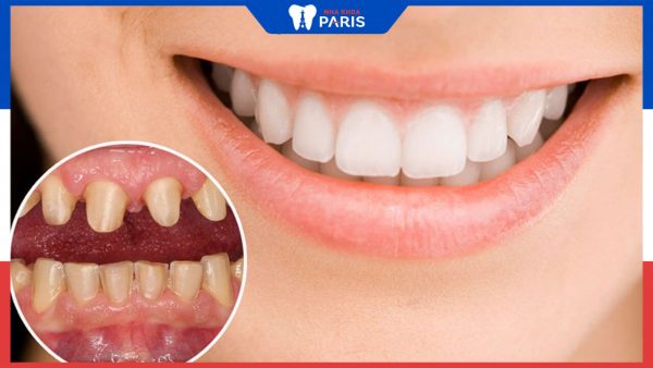 Tác hại của bọc răng sứ thẩm mỹ là gì? Lưu ý để bọc răng sứ an toàn.