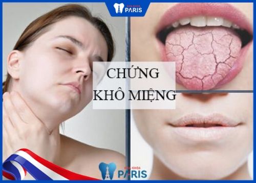 Lưỡi trắng vì sao? Khô môi, khô miệng gây ra tình trạng lưỡi trắng.