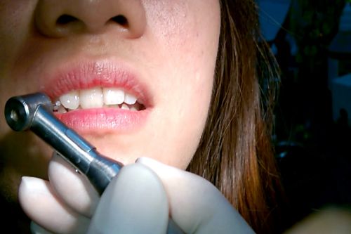 Đính đá răng công nghệ E.las được cơ sở nha khoa tân tiến ứng dụng.