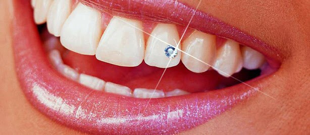 Công nghệ đính đá răng an toàn cần đảm bảo độ bền của viên đá và sức khỏe răng miệng của khách hàng